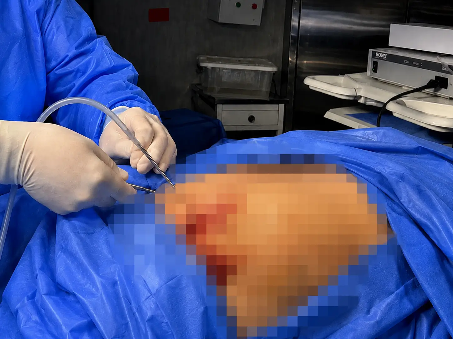 Dr. Freddy Castillo realizando una lipoescultura 360 en su clínica de San Borja, Lima