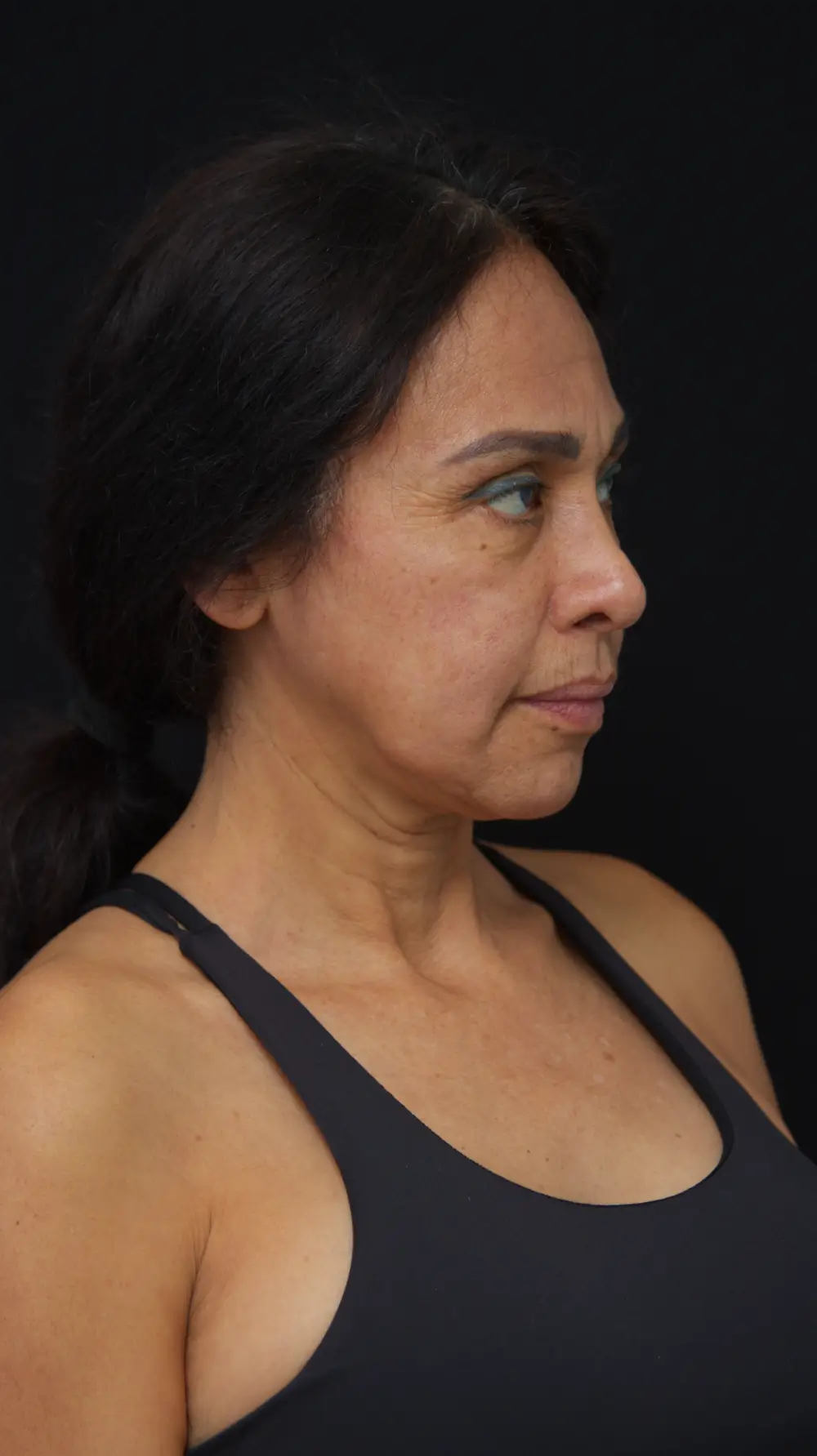 Antes del lifting facial