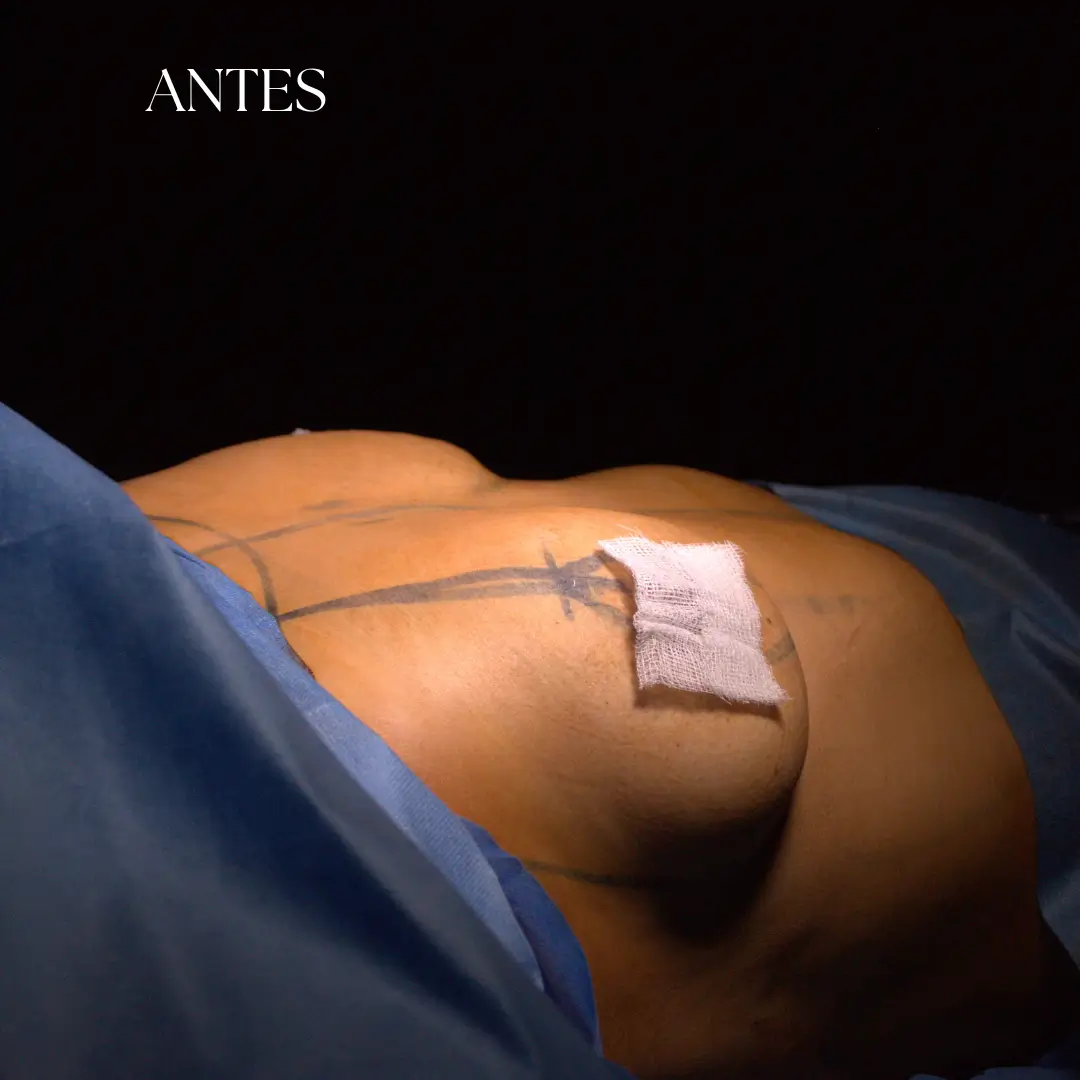 Foto del antes de una mamoplastia realizada por el Dr. Freddy Castillo