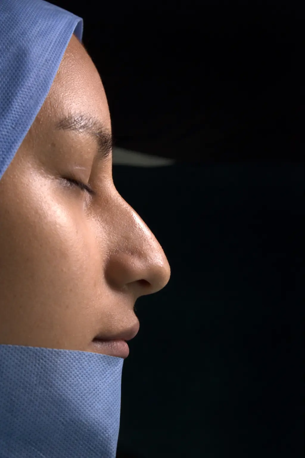 Antes del lifting facial