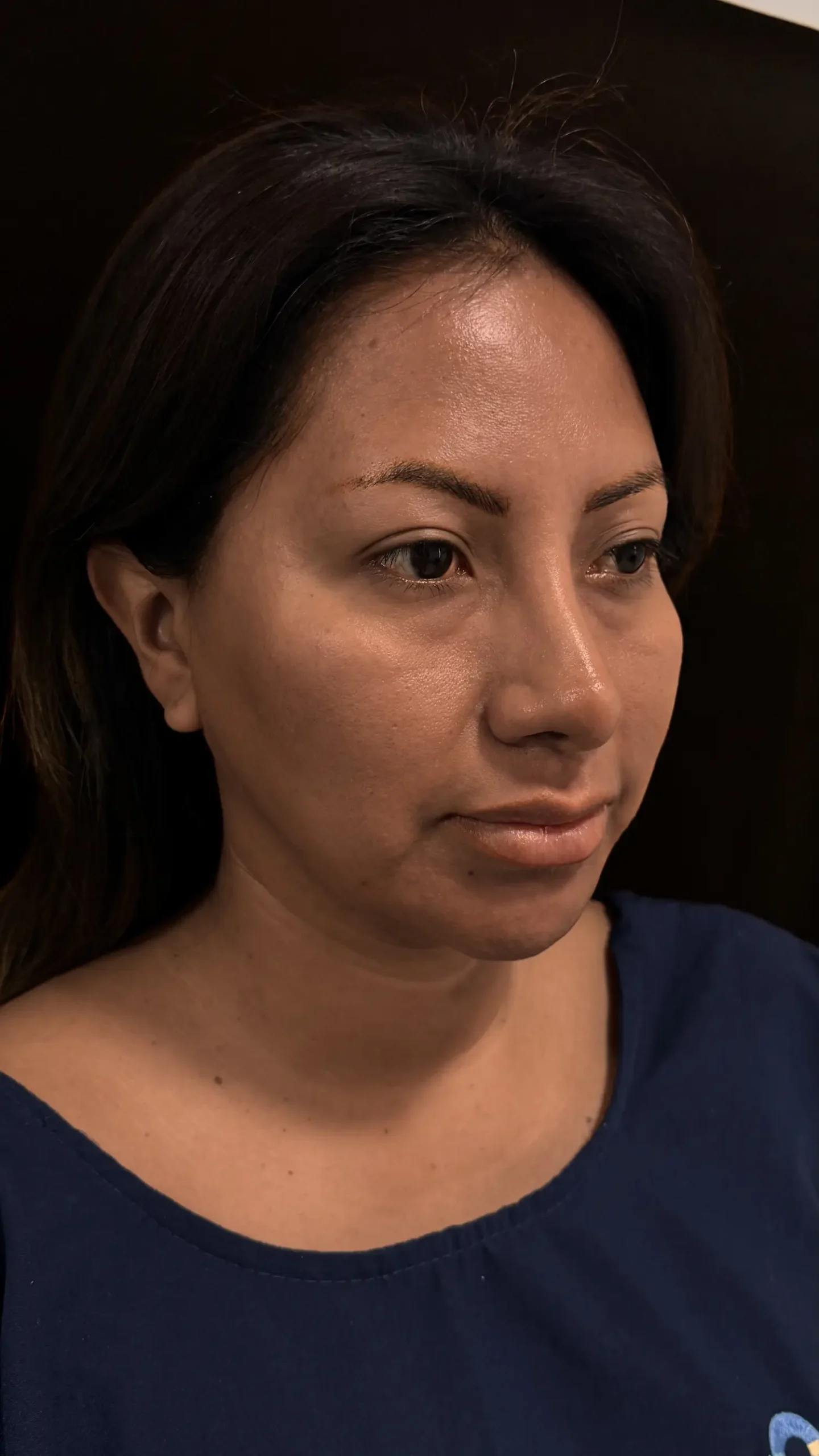 Antes del lifting facial