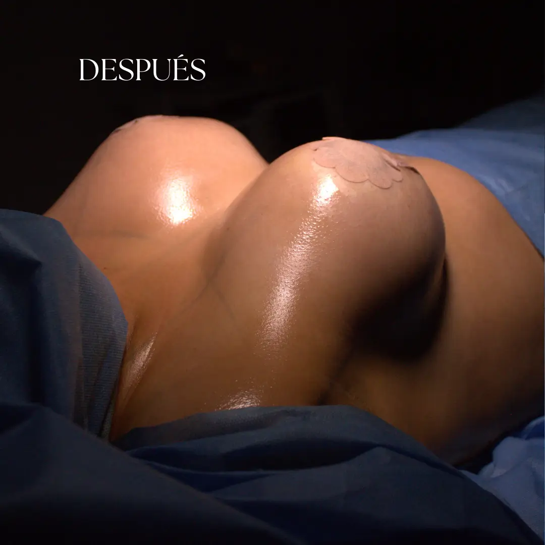 Foto del después de una mamoplastia realizada por el Dr. Freddy Castillo